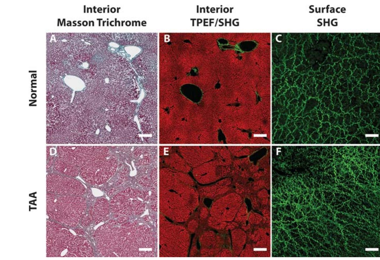Staging liver fibrosis by collagen imaging
